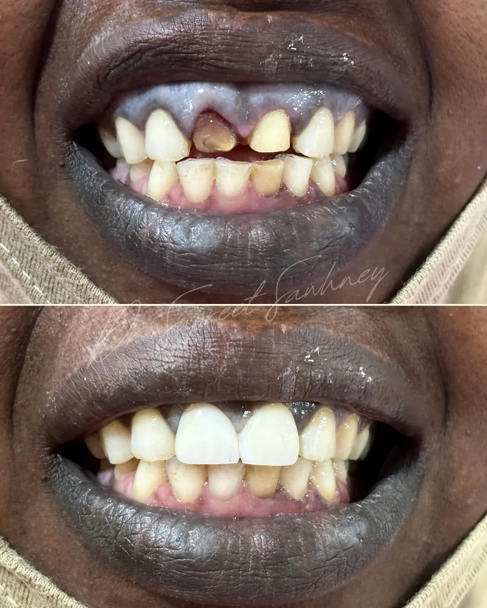 Before-and-after smile photographs documenting rehabilitation of fractured maxillary incisors